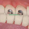 Dental orthodontic Monoblock Lingual bite opener / Orthodontic Lingual MIM Bite opener 10pcs/bag SE-O134 supplier